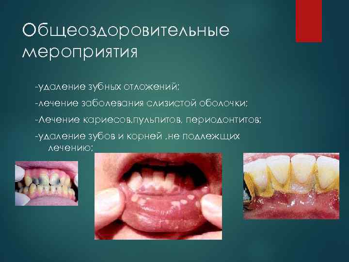 Общеоздоровительные мероприятия удаление зубных отложений; лечение заболевания слизистой оболочки; Лечение кариесов, пульпитов, периодонтитов; удаление