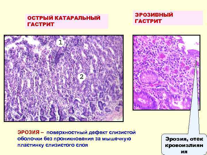 ОСТРЫЙ КАТАРАЛЬНЫЙ ГАСТРИТ ЭРОЗИВНЫЙ ГАСТРИТ ЭРОЗИЯ – поверхностный дефект слизистой оболочки без проникновения за