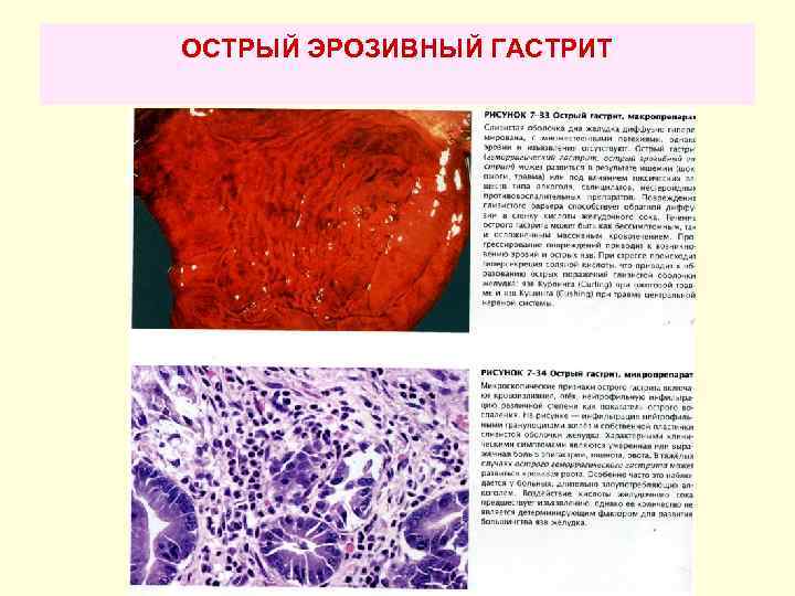 ОСТРЫЙ ЭРОЗИВНЫЙ ГАСТРИТ 