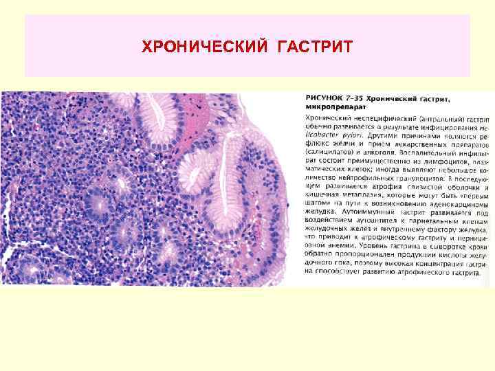 ХРОНИЧЕСКИЙ ГАСТРИТ 
