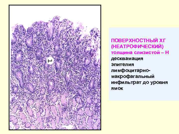 ПОВЕРХНОСТНЫЙ ХГ (НЕАТРОФИЧЕСКИЙ) толщина слизистой – Н десквамация эпителия лимфоцитарномакрофагальный инфильтрат до уровня ямок