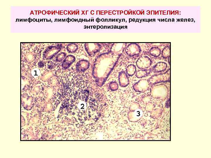 АТРОФИЧЕСКИЙ ХГ С ПЕРЕСТРОЙКОЙ ЭПИТЕЛИЯ: лимфоциты, лимфоидный фолликул, редукция числа желез, энтеролизация 