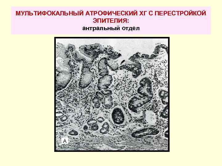 МУЛЬТИФОКАЛЬНЫЙ АТРОФИЧЕСКИЙ ХГ С ПЕРЕСТРОЙКОЙ ЭПИТЕЛИЯ: антральный отдел 