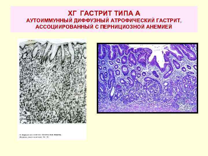 Hp ассоциированный гастрит что это