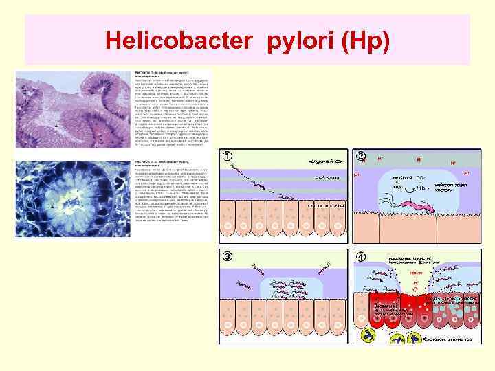 Helicobacter pylori (Hp) 