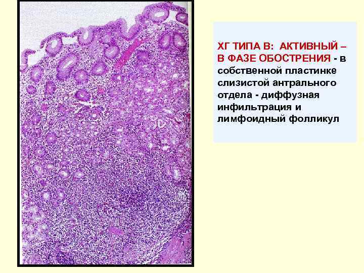 ХГ ТИПА В: АКТИВНЫЙ – В ФАЗЕ ОБОСТРЕНИЯ - в собственной пластинке слизистой антрального