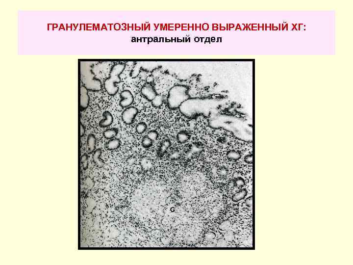 ГРАНУЛЕМАТОЗНЫЙ УМЕРЕННО ВЫРАЖЕННЫЙ ХГ: антральный отдел 