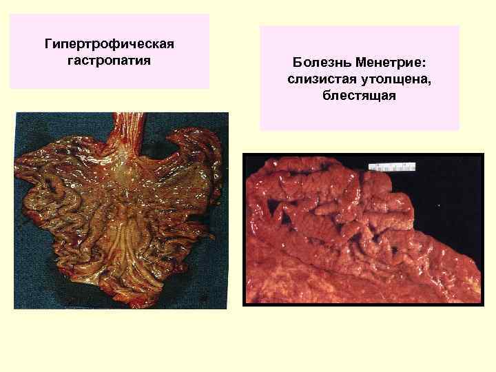 Гипертрофическая гастропатия Болезнь Менетрие: слизистая утолщена, блестящая 