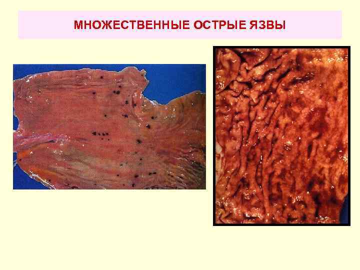 МНОЖЕСТВЕННЫЕ ОСТРЫЕ ЯЗВЫ 