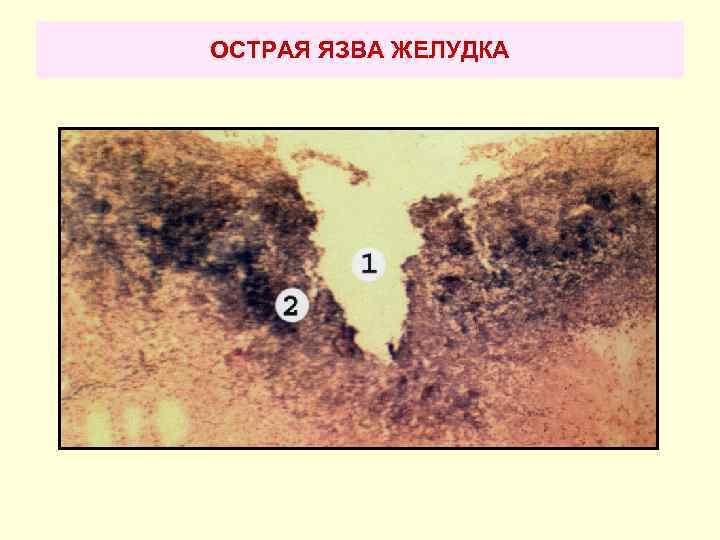 ОСТРАЯ ЯЗВА ЖЕЛУДКА 