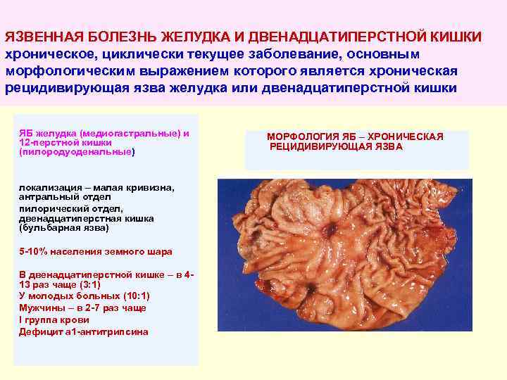 ЯЗВЕННАЯ БОЛЕЗНЬ ЖЕЛУДКА И ДВЕНАДЦАТИПЕРСТНОЙ КИШКИ хроническое, циклически текущее заболевание, основным морфологическим выражением которого