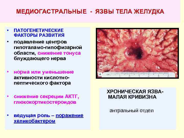МЕДИОГАСТРАЛЬНЫЕ - ЯЗВЫ ТЕЛА ЖЕЛУДКА • ПАТОГЕНЕТИЧЕСКИЕ ФАКТОРЫ РАЗВИТИЯ • подавление центров гипоталамо-гипофизарной области,