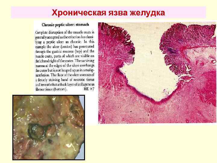 Хроническая язва желудка 