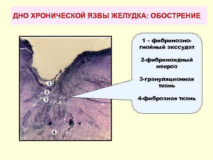 ДНО ХРОНИЧЕСКОЙ ЯЗВЫ ЖЕЛУДКА: ОБОСТРЕНИЕ 1 – фибринозногнойный экссудат 2 -фибриноидный некроз 3 -грануляционная