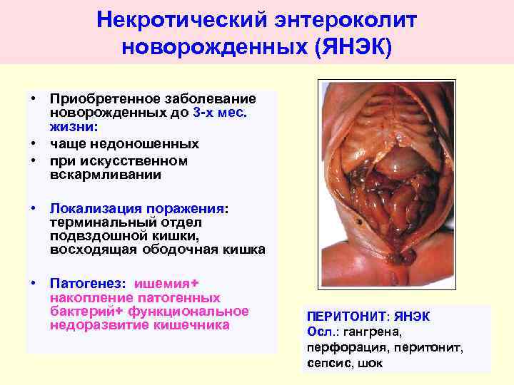 Некротический энтероколит новорожденных (ЯНЭК) • Приобретенное заболевание новорожденных до 3 -х мес. жизни: •