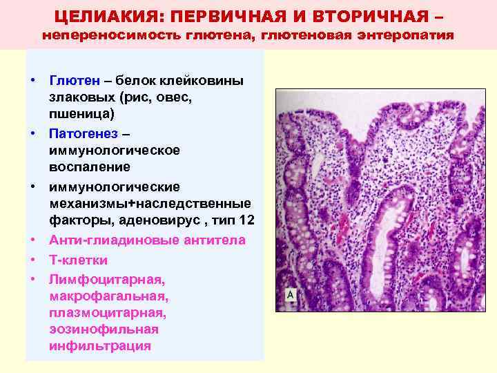 Экссудативная энтеропатия презентация