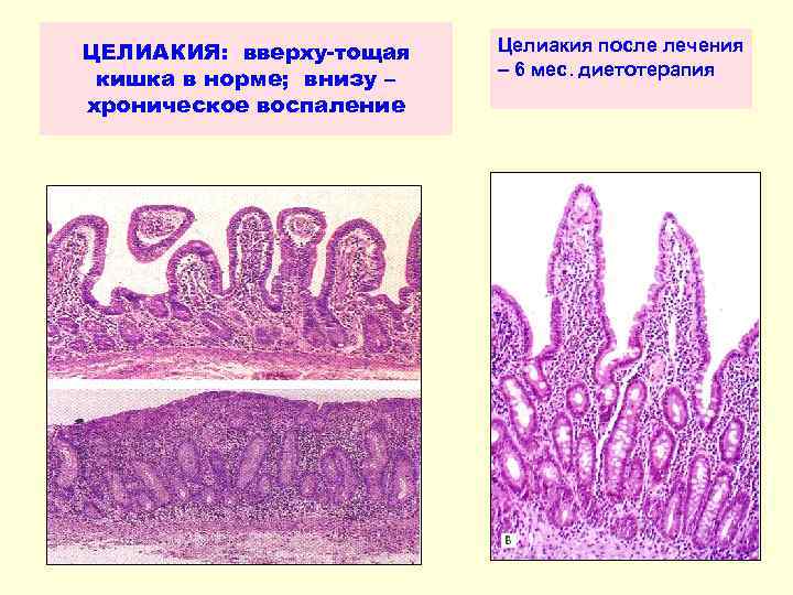 ЦЕЛИАКИЯ: вверху-тощая кишка в норме; внизу – хроническое воспаление Целиакия после лечения – 6