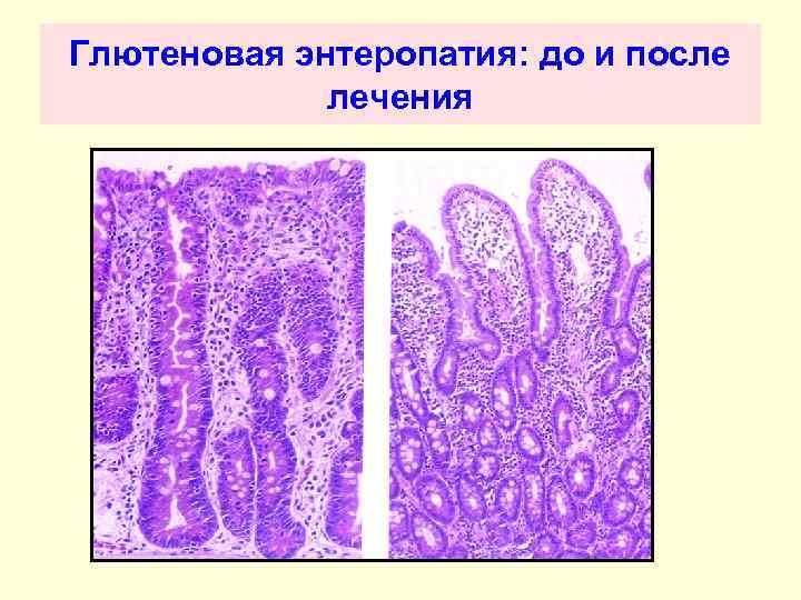 Глютеновая энтеропатия: до и после лечения 