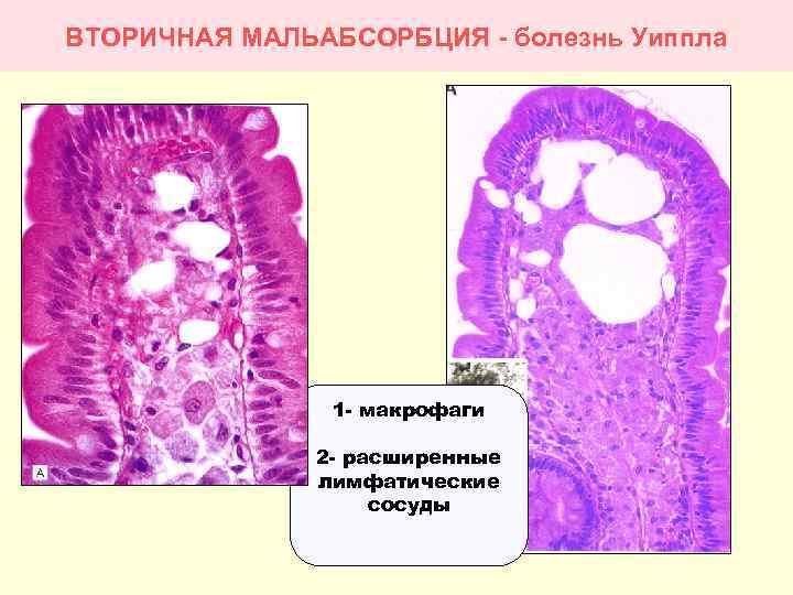 Болезнь уиппла презентация