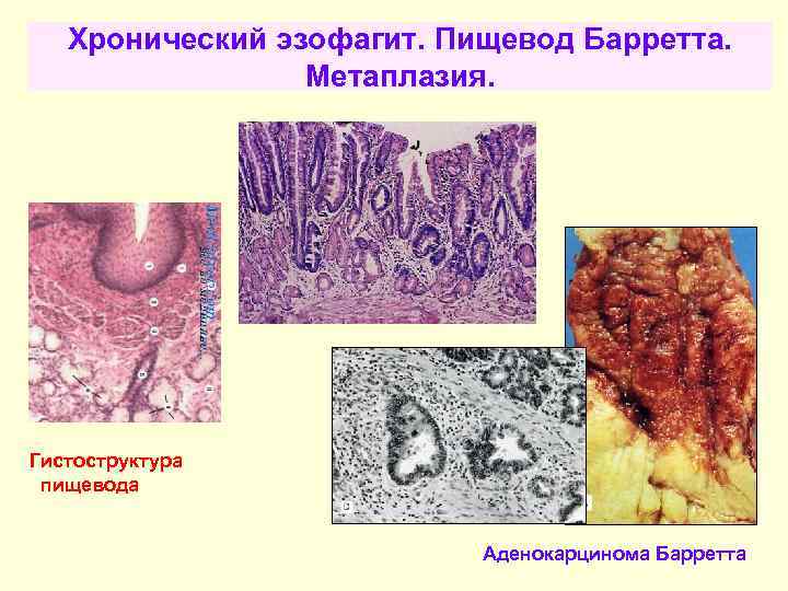 Хронический эзофагит. Пищевод Барретта. Метаплазия. Гистоструктура пищевода Аденокарцинома Барретта 
