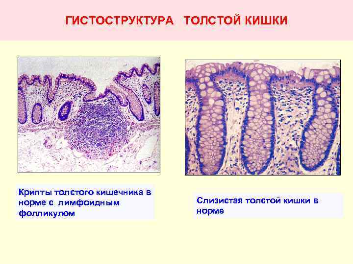 ГИСТОСТРУКТУРА ТОЛСТОЙ КИШКИ Крипты толстого кишечника в норме с лимфоидным фолликулом Слизистая толстой кишки