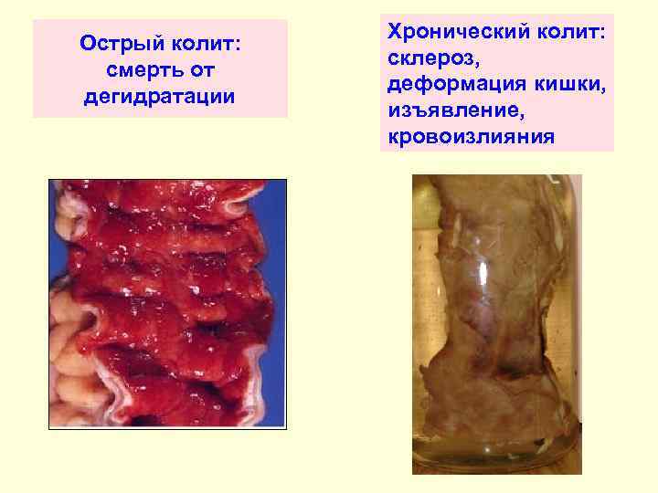 Острый колит: смерть от дегидратации Хронический колит: склероз, деформация кишки, изъявление, кровоизлияния 