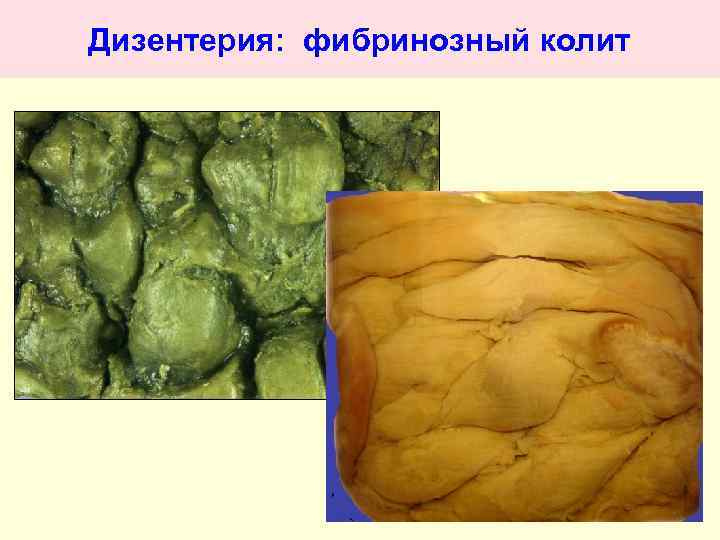 Дизентерия: фибринозный колит 