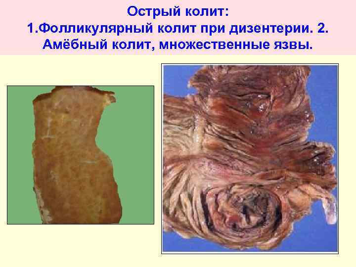 Острый колит: 1. Фолликулярный колит при дизентерии. 2. Амёбный колит, множественные язвы. 