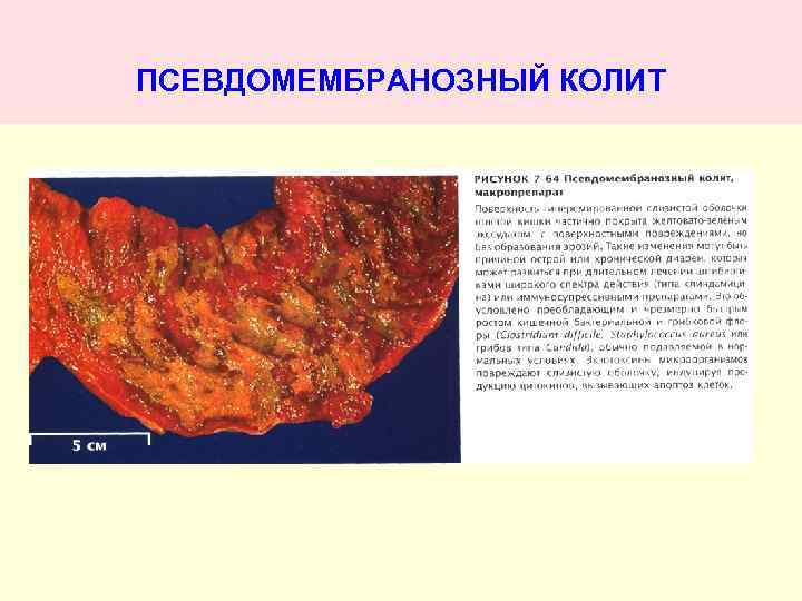 ПСЕВДОМЕМБРАНОЗНЫЙ КОЛИТ 
