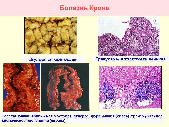 Болезнь Крона «Булыжная мостовая» Гранулемы в толстом кишечнике Толстая кишка: «булыжная мостовая, склероз, деформация