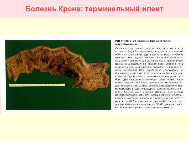 Болезнь Крона: терминальный илеит 