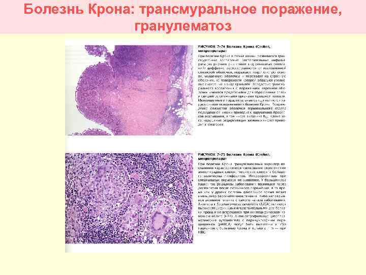 Болезнь Крона: трансмуральное поражение, гранулематоз 