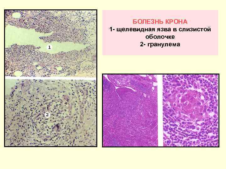 Болезнь крона гистологическая картина