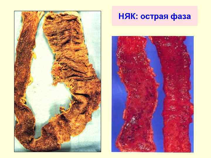 НЯК: острая фаза 