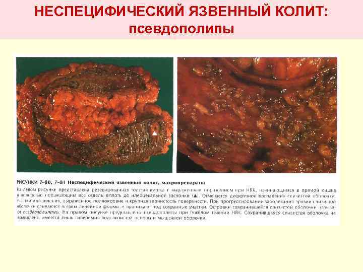 НЕСПЕЦИФИЧЕСКИЙ ЯЗВЕННЫЙ КОЛИТ: псевдополипы 