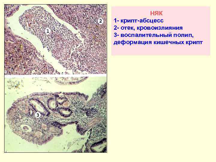  НЯК 1 - крипт-абсцесс 2 - отек, кровоизлияния 3 - воспалительный полип, деформация