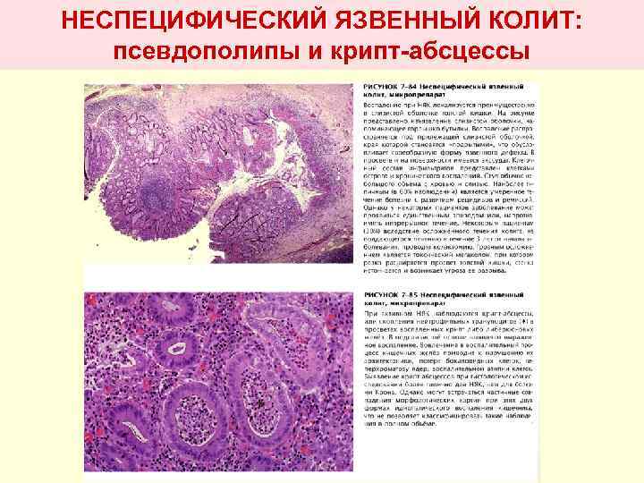 НЕСПЕЦИФИЧЕСКИЙ ЯЗВЕННЫЙ КОЛИТ: псевдополипы и крипт-абсцессы 