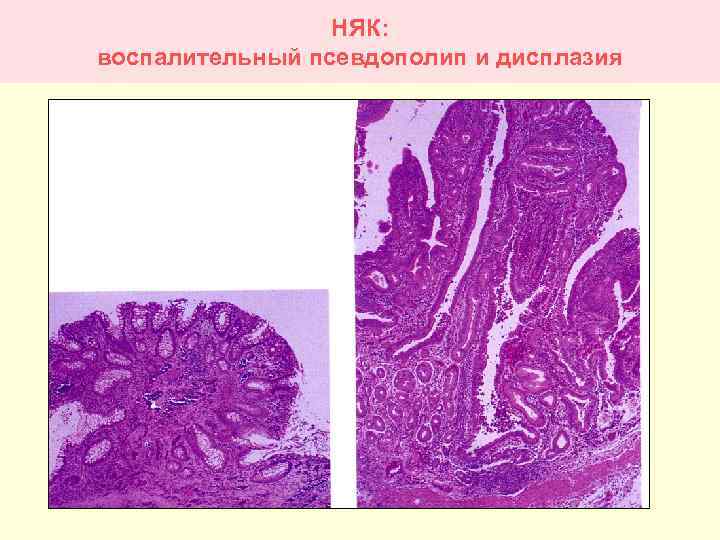 НЯК: воспалительный псевдополип и дисплазия 