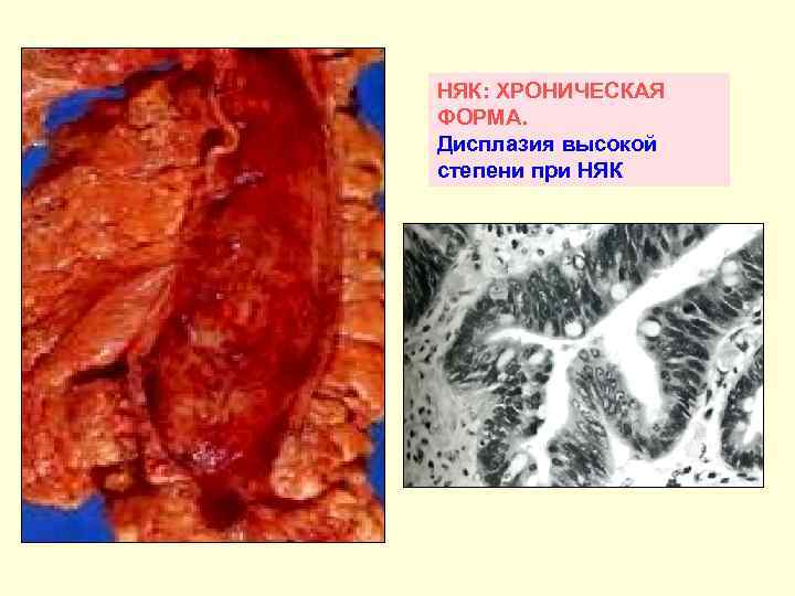 НЯК: ХРОНИЧЕСКАЯ ФОРМА. Дисплазия высокой степени при НЯК 