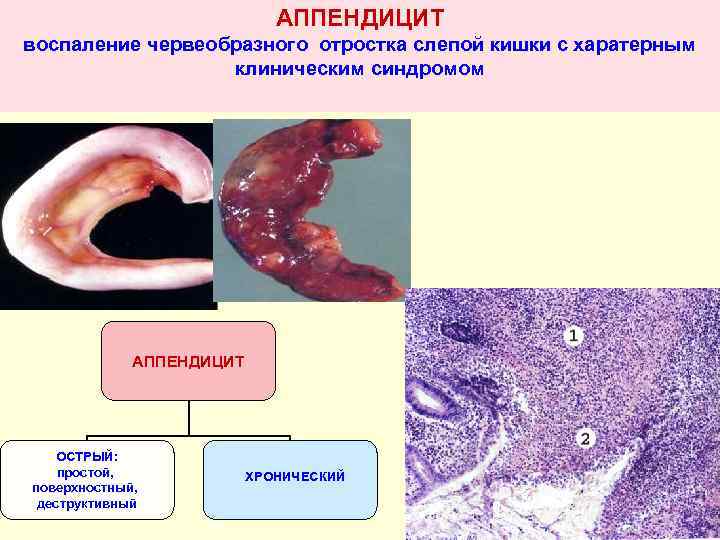 АППЕНДИЦИТ воспаление червеобразного отростка слепой кишки с харатерным клиническим синдромом АППЕНДИЦИТ ОСТРЫЙ: простой, поверхностный,