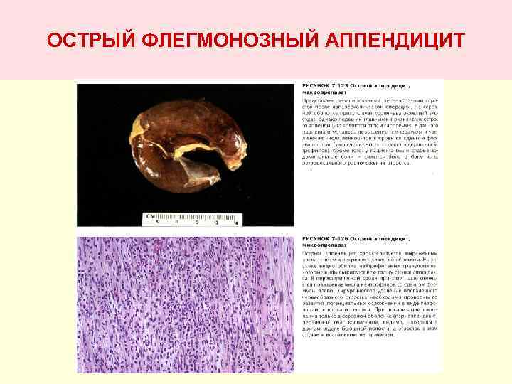 ОСТРЫЙ ФЛЕГМОНОЗНЫЙ АППЕНДИЦИТ 