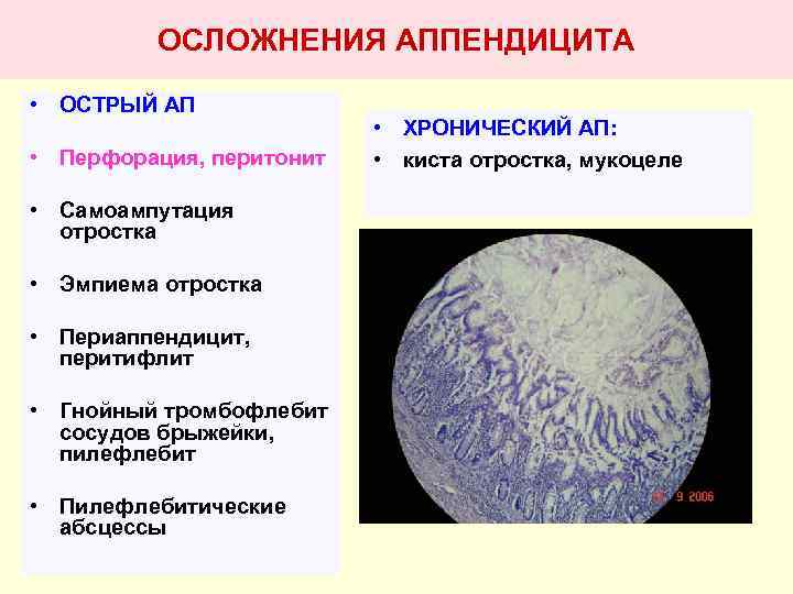 ОСЛОЖНЕНИЯ АППЕНДИЦИТА • ОСТРЫЙ АП • Перфорация, перитонит • Самоампутация отростка • Эмпиема отростка