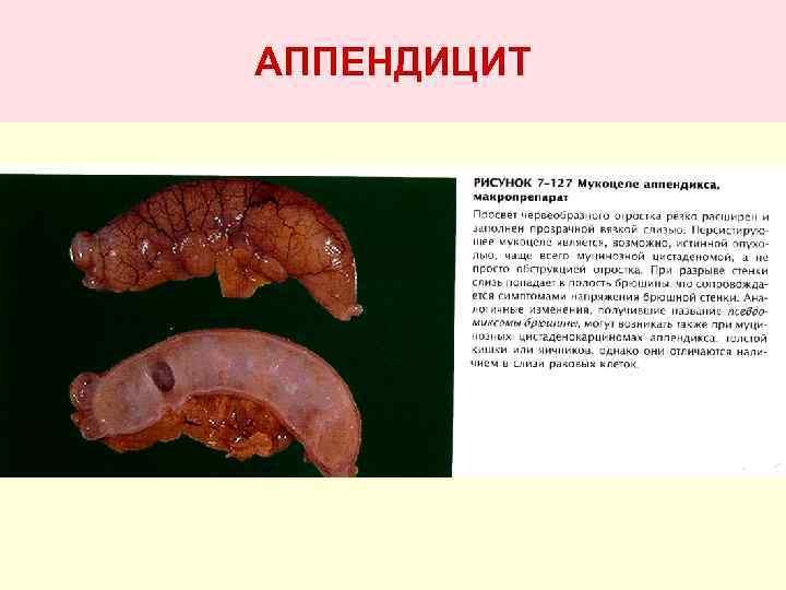АППЕНДИЦИТ 