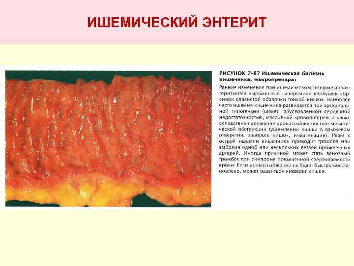 ИШЕМИЧЕСКИЙ ЭНТЕРИТ 