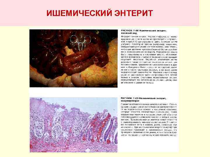 ИШЕМИЧЕСКИЙ ЭНТЕРИТ 