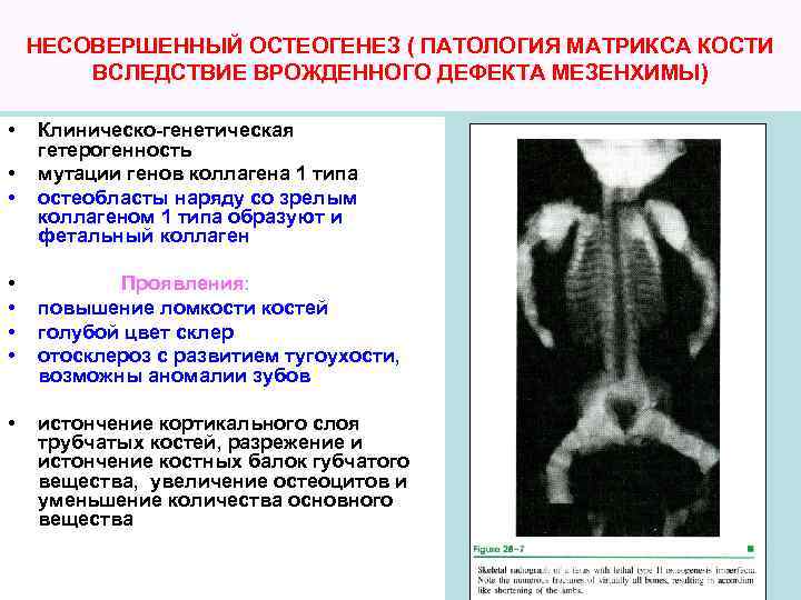 НЕСОВЕРШЕННЫЙ ОСТЕОГЕНЕЗ ( ПАТОЛОГИЯ МАТРИКСА КОСТИ ВСЛЕДСТВИЕ ВРОЖДЕННОГО ДЕФЕКТА МЕЗЕНХИМЫ) • • • Клиническо-генетическая