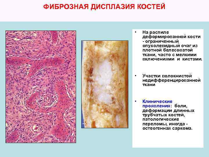 ФИБРОЗНАЯ ДИСПЛАЗИЯ КОСТЕЙ • На распиле деформированной кости - ограниченный опухолевидный очаг из плотной