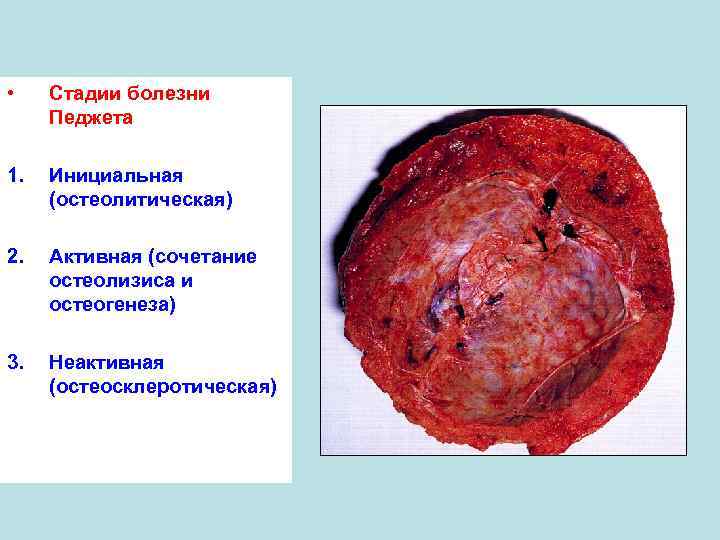  • Стадии болезни Педжета 1. Инициальная (остеолитическая) 2. Активная (сочетание остеолизиса и остеогенеза)