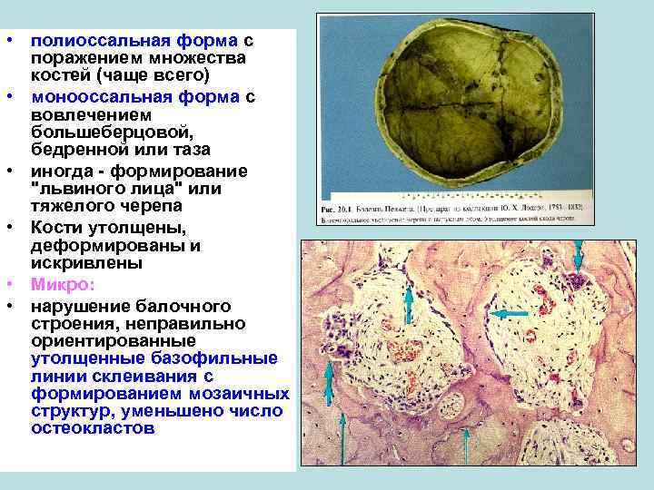  • полиоссальная форма с поражением множества костей (чаще всего) • монооссальная форма с