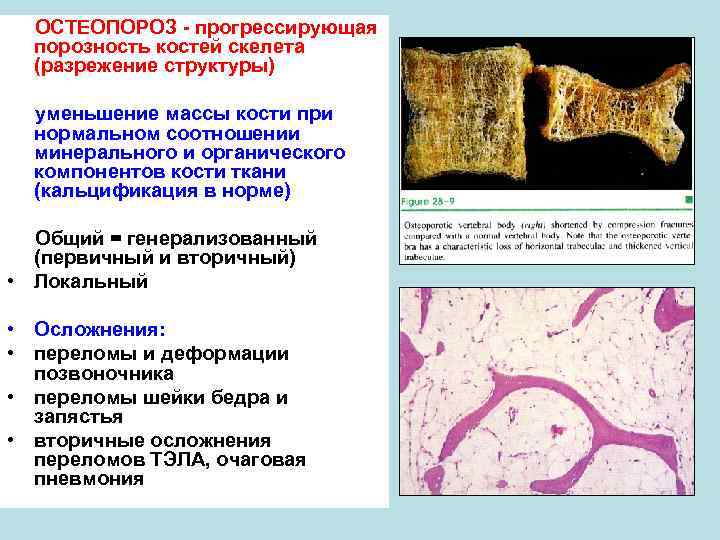 Поражение костей скелета